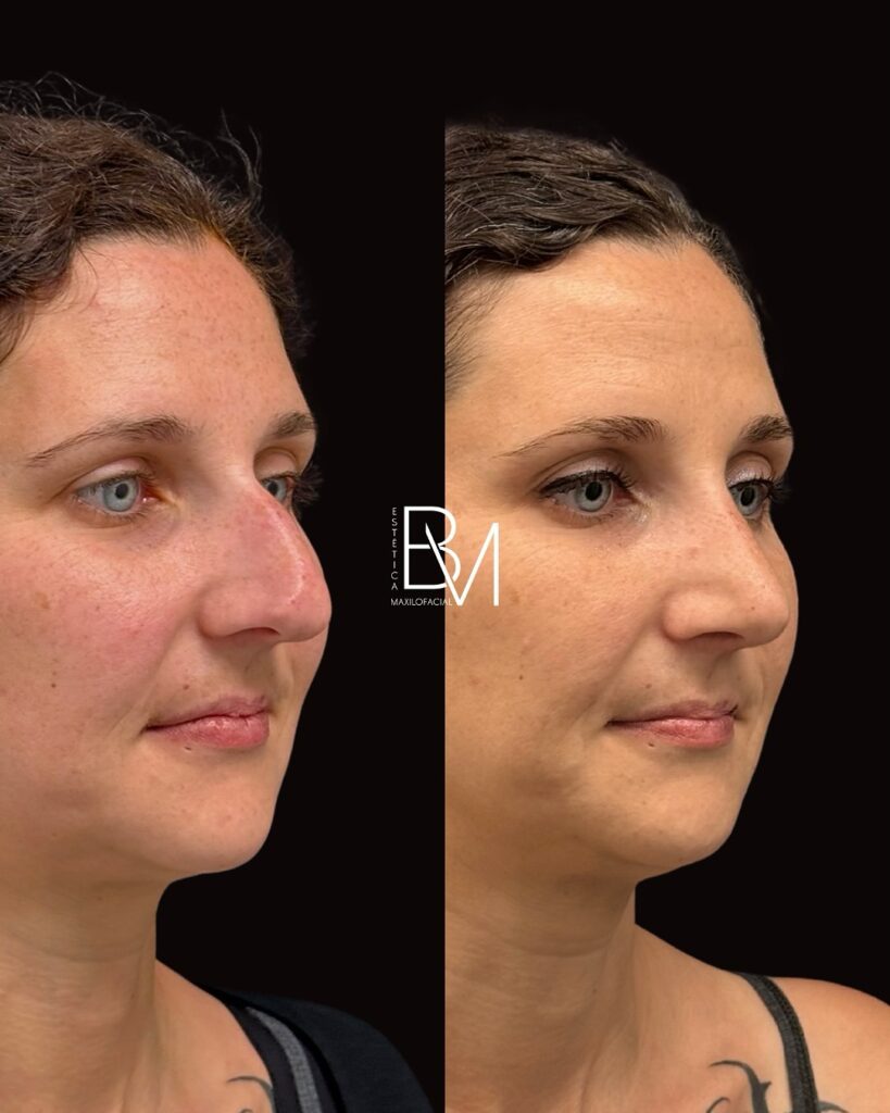 ANTES y DESPUÉS de una rinoplastia ultrasónica con DORSO RECTO😍¿A ti también te pasa que no te