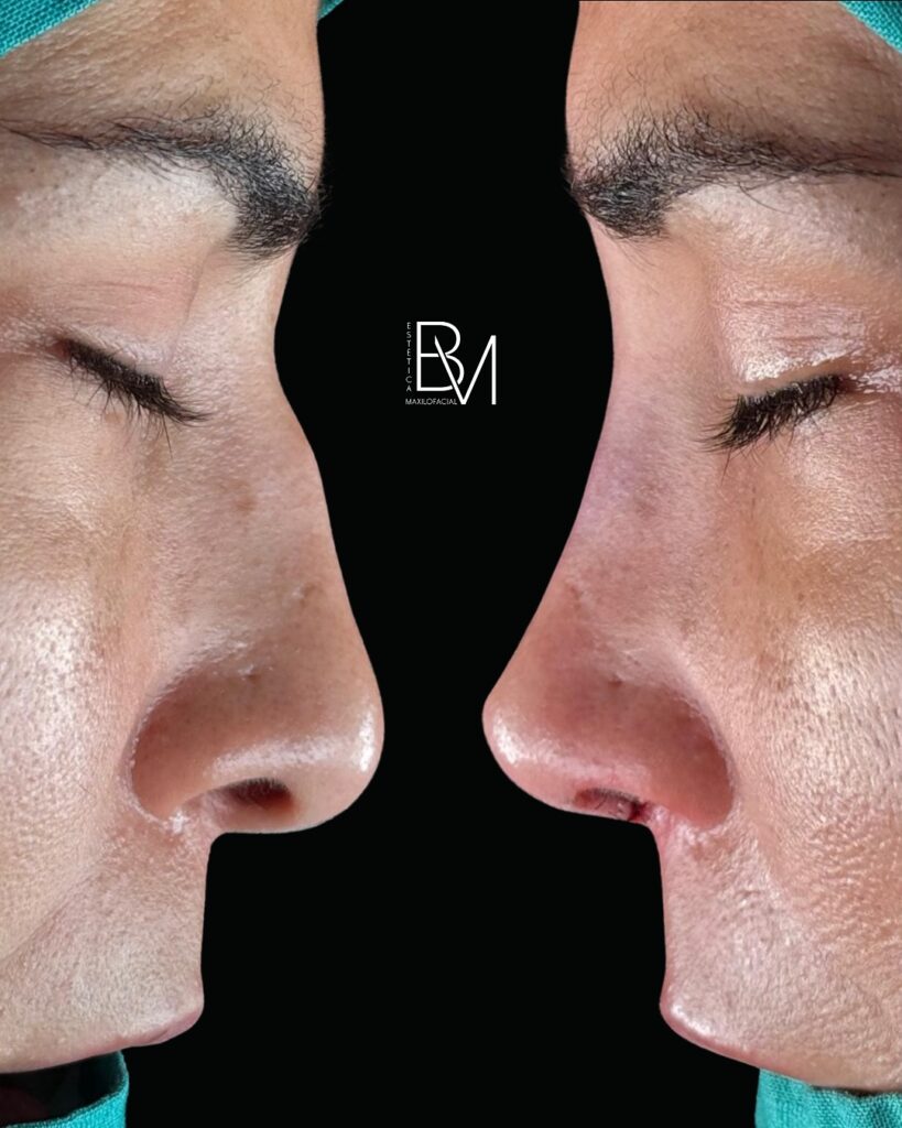 Cada caso es único- hay narices que buscan suavizar un perfil, otras corregir un tabique desviad