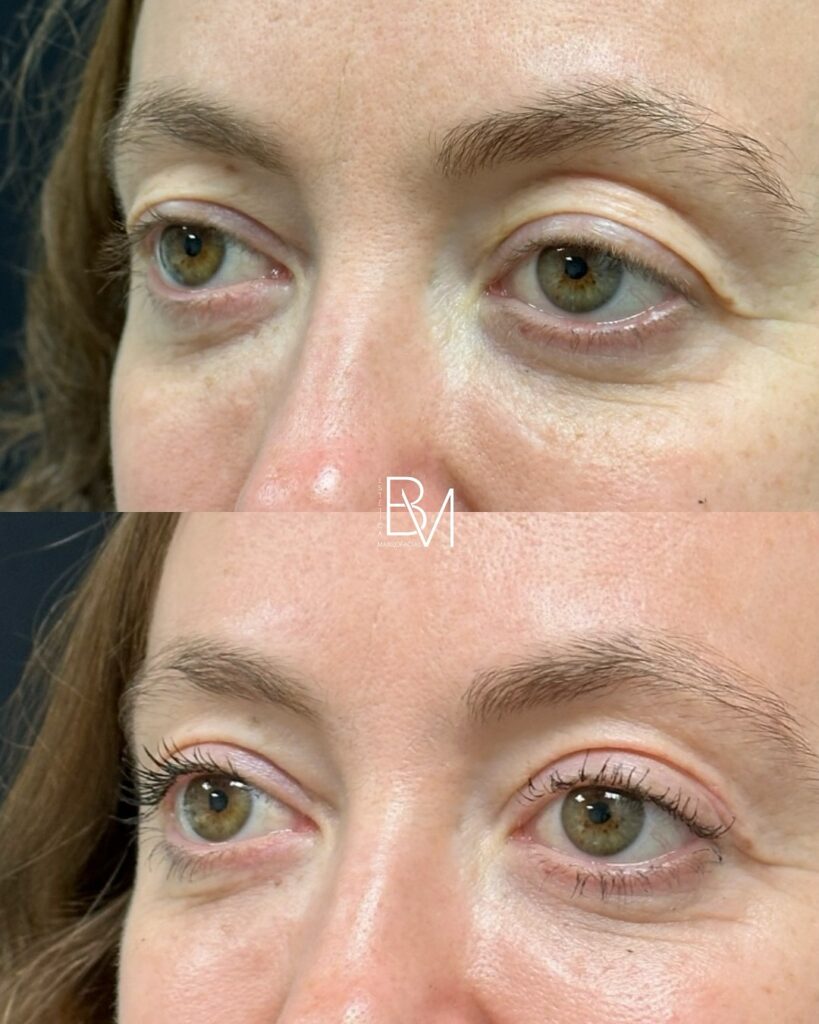 Esta paciente llegó con ganas de verse más despierta 👀✨ sin perder su mirada natural.La blefaro