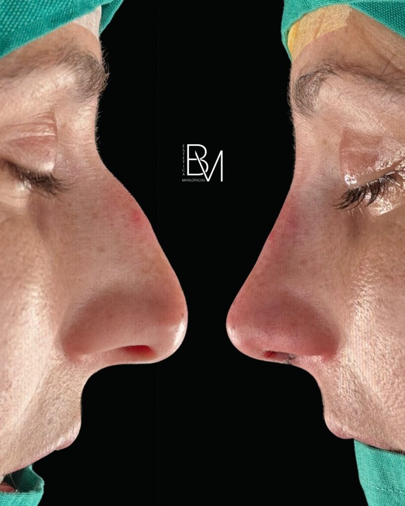 RINOPLASTIA ULTRASÓNICA, este tratamiento no solo mejora la forma de la nariz, sino que también