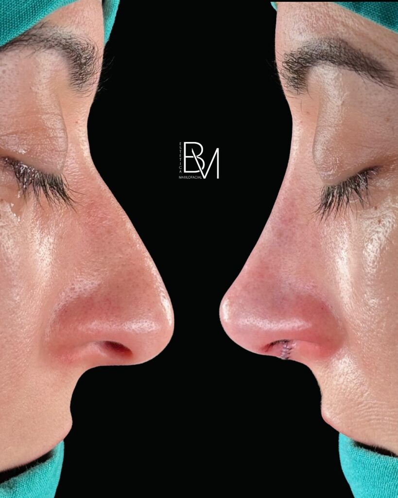 ✨ Una nariz puede cambiar mucho más que un perfil- puede transformar la forma en que te miras al
